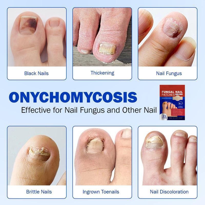 Fungal Nail Patches